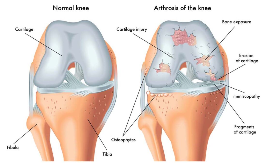 5 Tips to Prevent & Slow Down Osteoarthritis