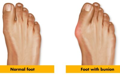 Treating Common Foot Issues – Bunions