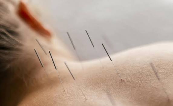 Acupuncture needles placed along the back