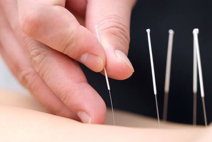 Acupuncture treatment Acupuncture treatment with fine needles