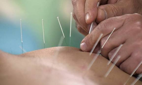 Acupuncture practitioner inserting treatment needles